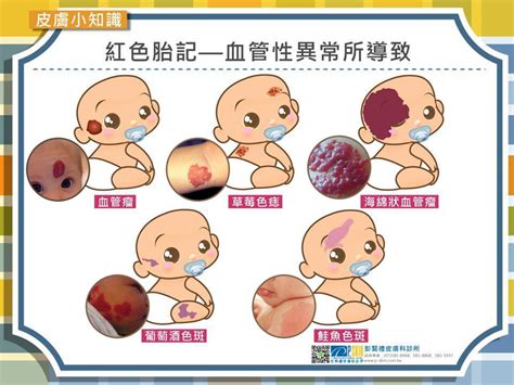 腳底有紅色胎記|腳底有紅色胎記怎麼回事